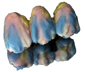 Couronne céramo-métallique