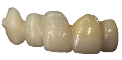 Restauration provisoire en PMMA