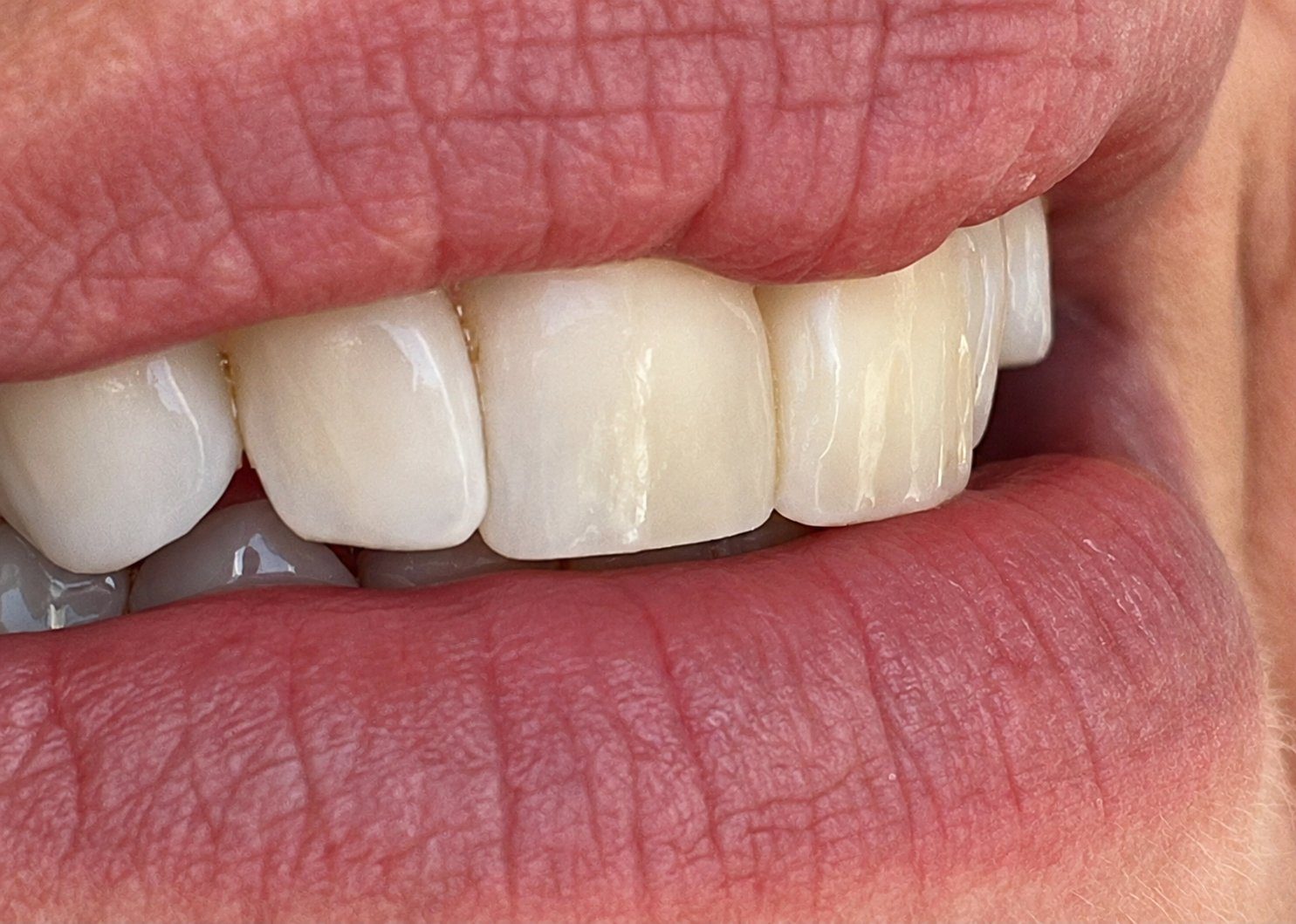 Dents antérieures