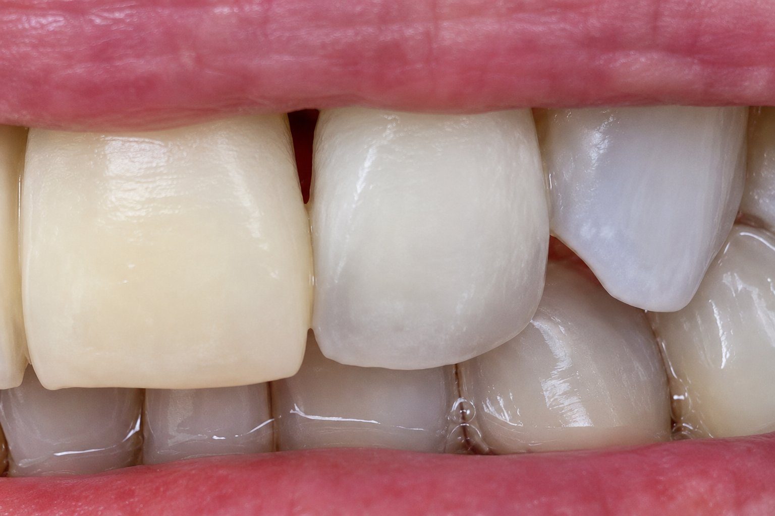 Détail de dents antérieures